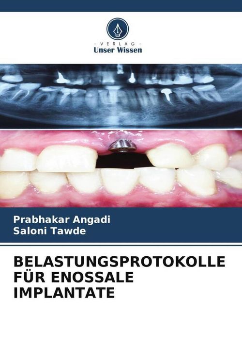 Produktbild: Belastungsprotokolle f&uuml;r Enossale Implantate