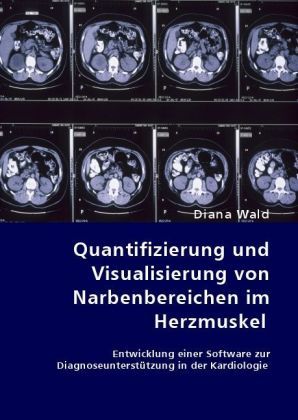 Produktbild: Quantifizierung und Visualisierung von Narbenbereichen im Herzmuskel