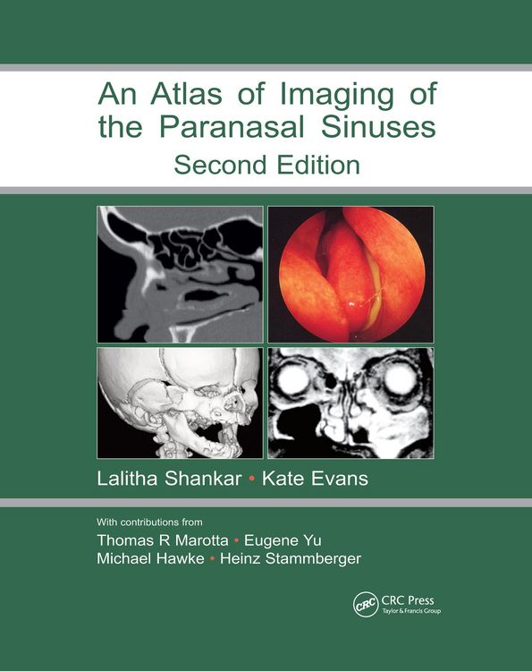 Produktbild: Atlas of Imaging of the Paranasal Sinuses, Second Edition