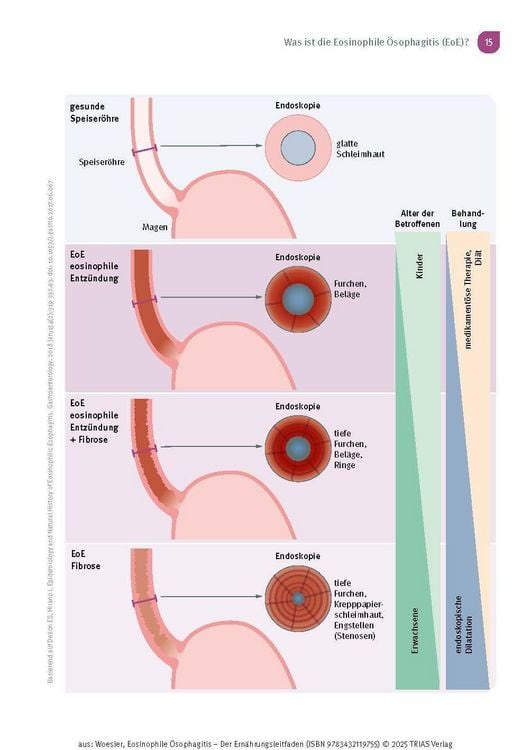 Produktbild: Eosinophile &Ouml;sophagitis - Der Ern&auml;hrungsleitfaden