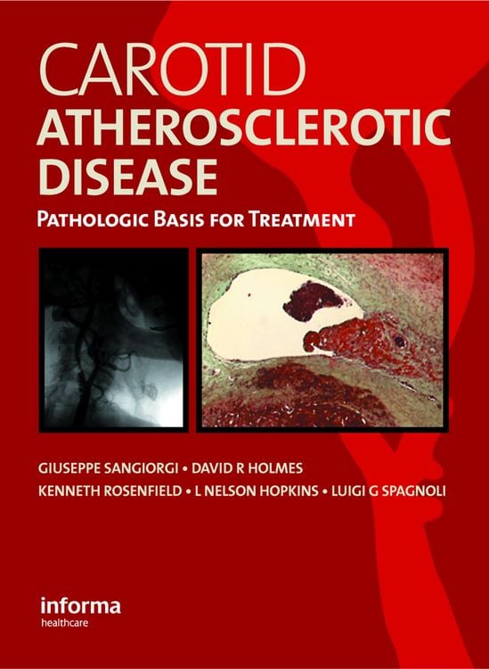 Produktbild: Carotid Atherosclerotic Disease