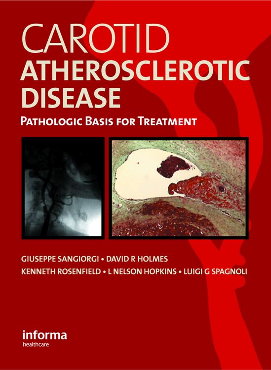 Produktbild: Carotid Atherosclerotic Disease
