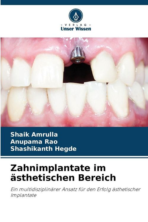 Produktbild: Zahnimplantate im &auml;sthetischen Bereich