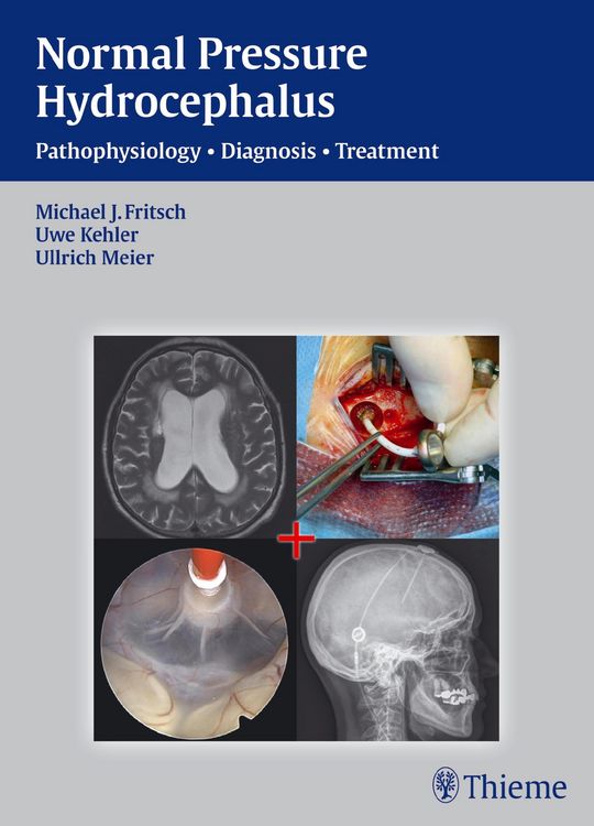Produktbild: Normal Pressure Hydrocephalus