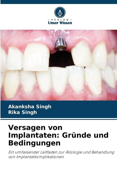 Produktbild: Versagen von Implantaten: Gr&uuml;nde und Bedingungen