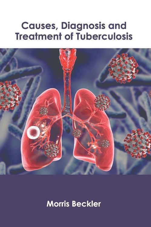 Produktbild: Causes, Diagnosis and Treatment of Tuberculosis