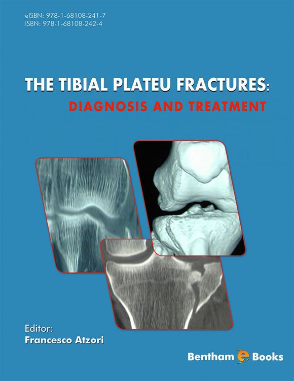 Produktbild: The Tibial Plateau Fractures: Diagnosis and Treatment