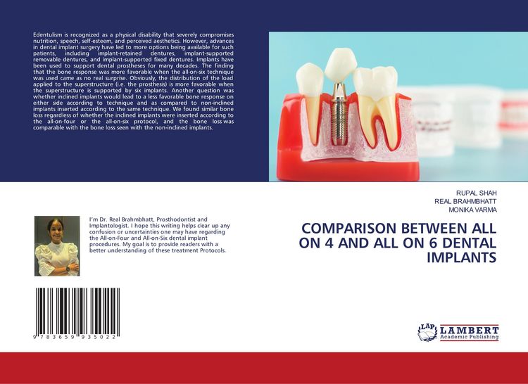 Produktbild: Comparison Between All On 4 and All On 6 Dental Implants