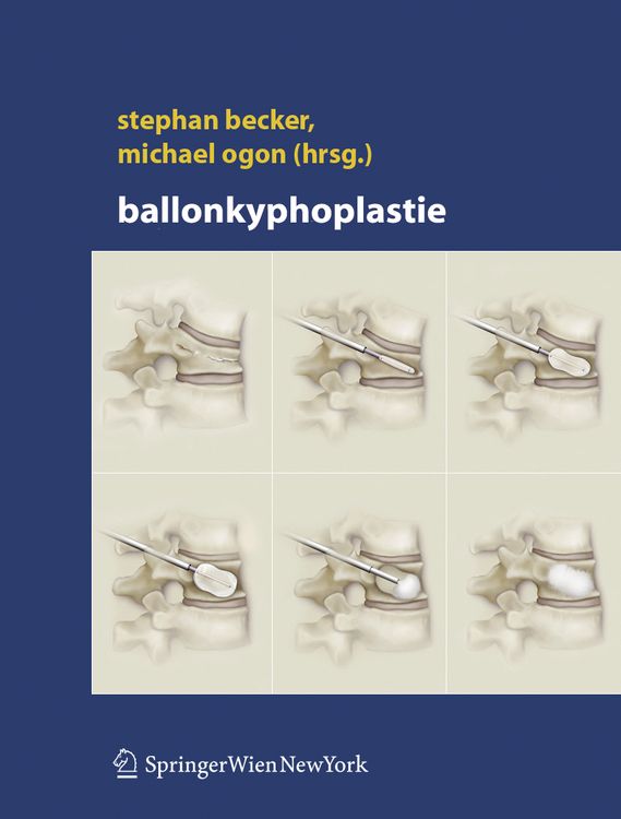 Produktbild: Ballonkyphoplastie