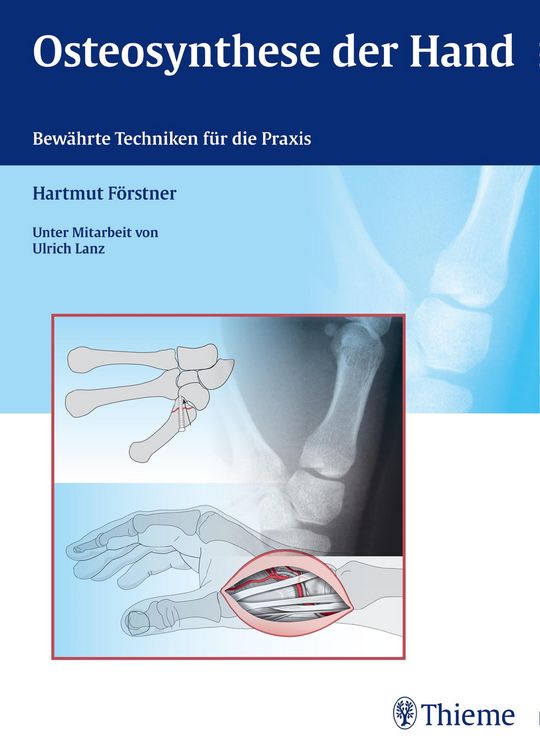 Produktbild: Osteosynthese der Hand