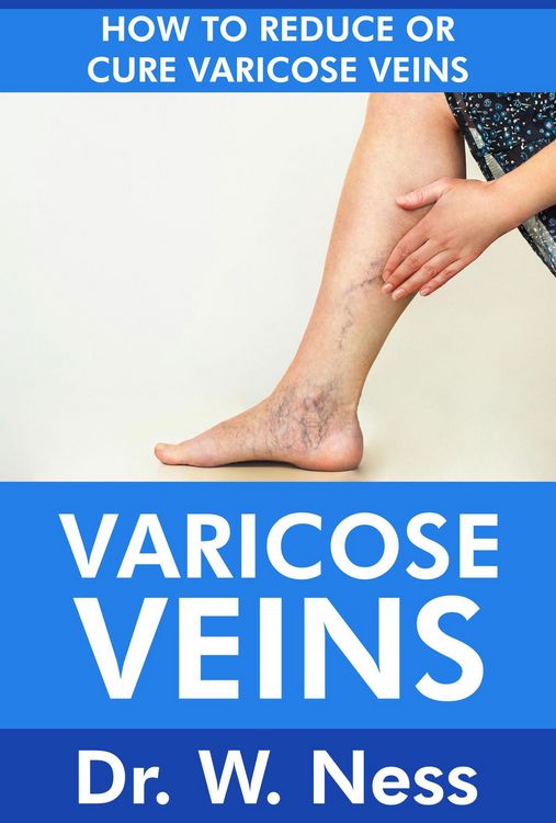 Produktbild: Varicose Veins: How To Reduce Or Cure Varicose Veins