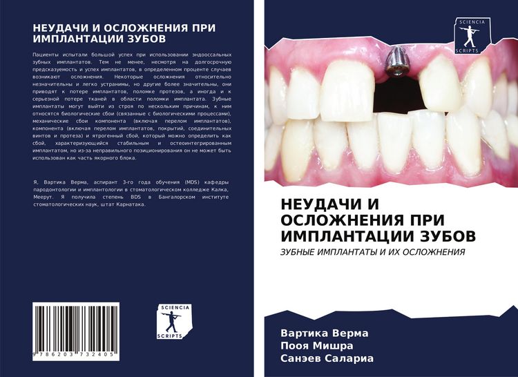 Produktbild: Neudachi I Oslozhneniya Pri Implantacii Zubov