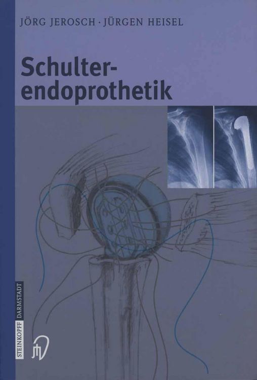 Produktbild: Schulterendoprothetik