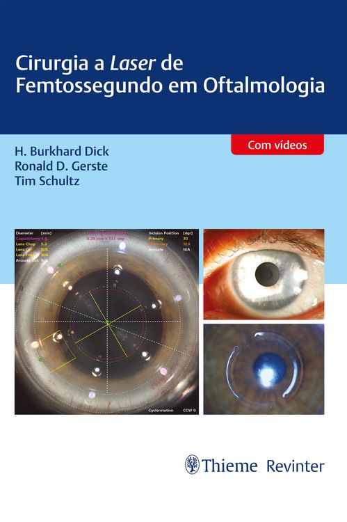Produktbild: Cirurgia a Laser de Femtossegundo em Oftalmologia