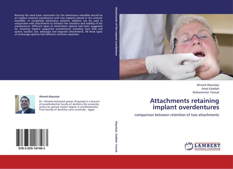 Produktbild: Attachments retaining implant overdentures