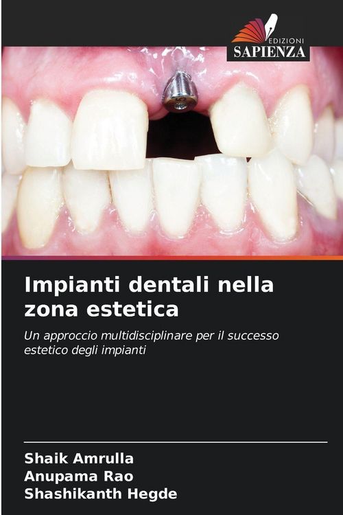 Produktbild: Impianti dentali nella zona estetica