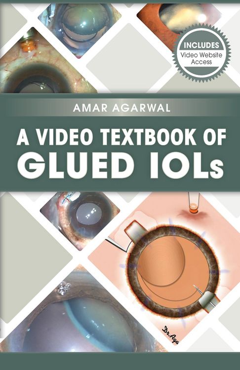 Produktbild: A Video Textbook of Glued IOLs