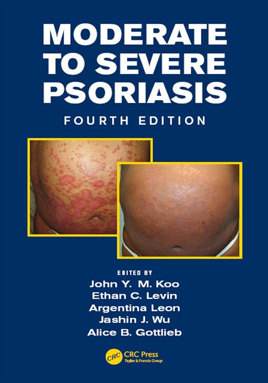 Produktbild: Moderate to Severe Psoriasis