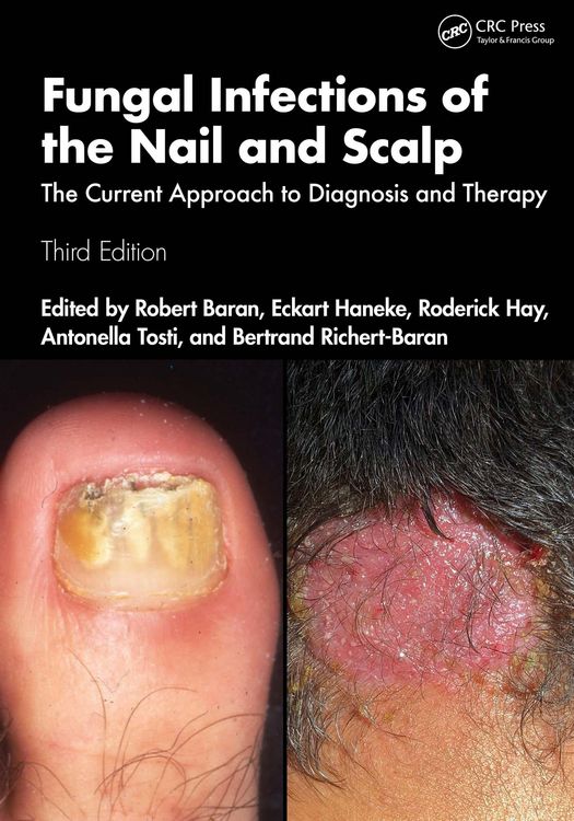 Produktbild: Fungal Infections of the Nail and Scalp