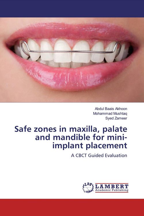 Produktbild: Safe zones in maxilla, palate and mandible for mini-implant placement