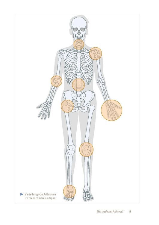 Produktbild: Arthrose