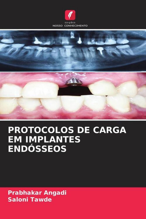 Produktbild: Protocolos De Carga Em Implantes End&oacute;sseos