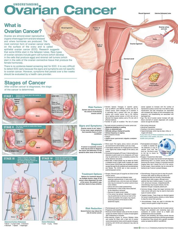 Produktbild: Understanding Ovarian Cancer Anatomical Chart