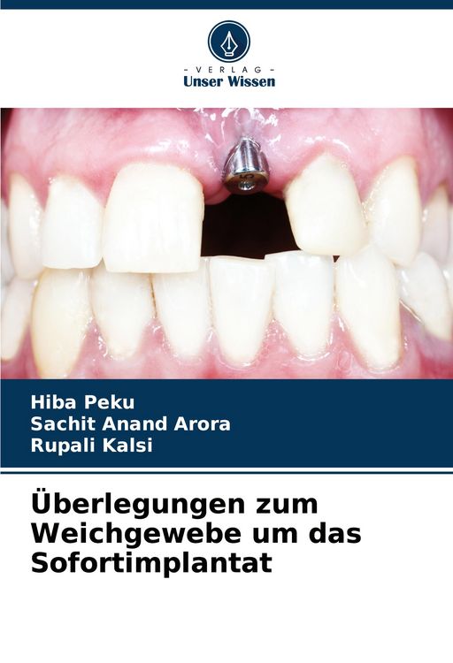Produktbild: &Uuml;berlegungen zum Weichgewebe um das Sofortimplantat