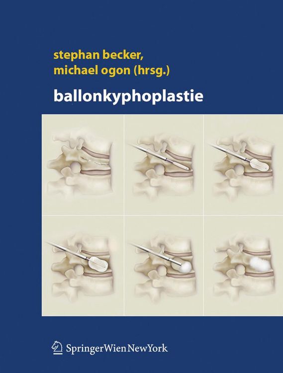 Produktbild: Ballonkyphoplastie