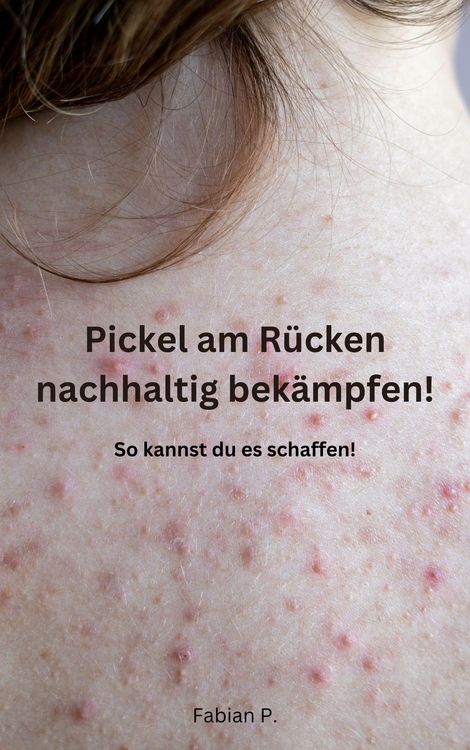 Produktbild: Pickel am R&uuml;cken nachhaltig bek&auml;mpfen!