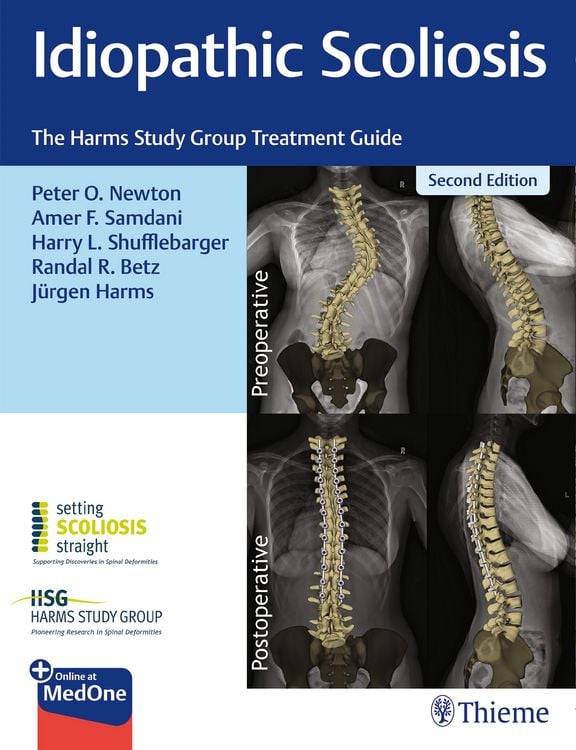Produktbild: Idiopathic Scoliosis