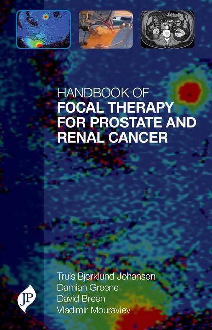 Produktbild: Johansen, T: Handbook of Focal Therapy for Prostate and Rena