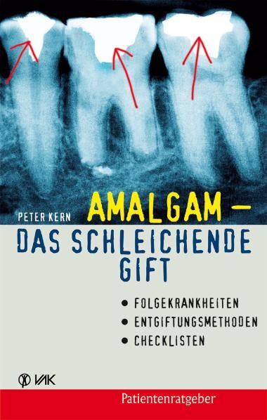 Produktbild: Amalgam - das schleichende Gift