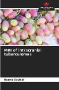 Produktbild: MRI of intracranial tuberculomas