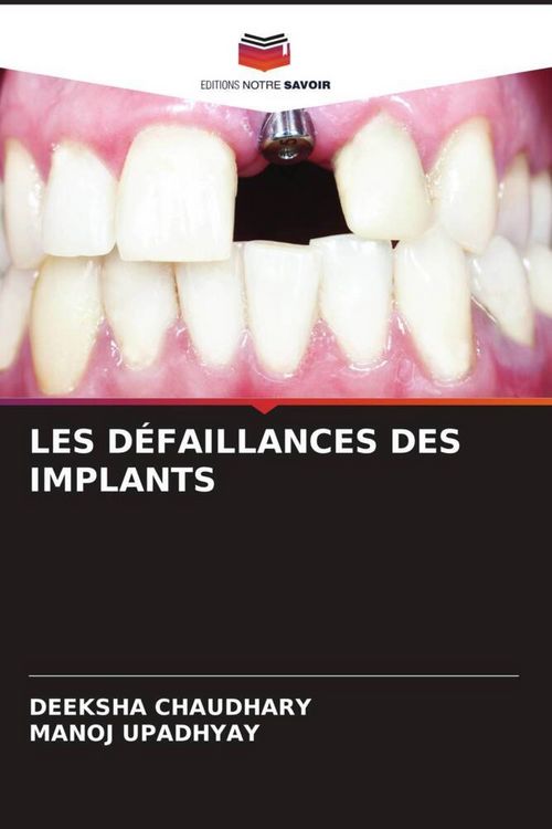 Produktbild: Les D&eacute;faillances des Implants