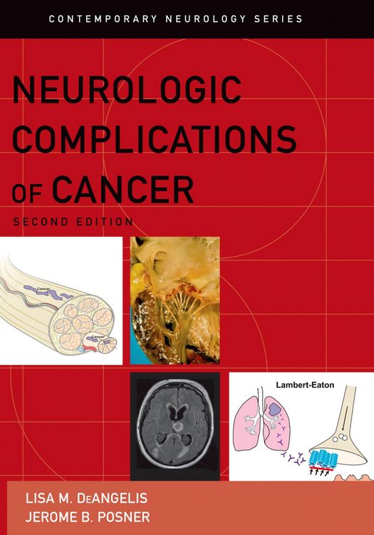 Produktbild: Neurologic Complications of Cancer