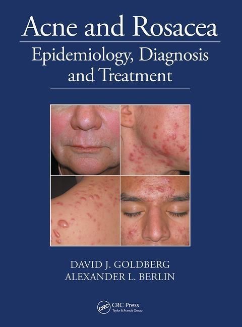 Produktbild: Goldberg, D: Acne and Rosacea