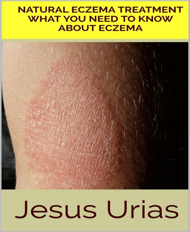 Produktbild: Natural Eczema Treatment