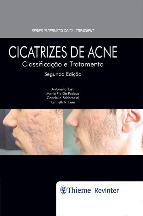 Produktbild: Cicatrizes de Acne