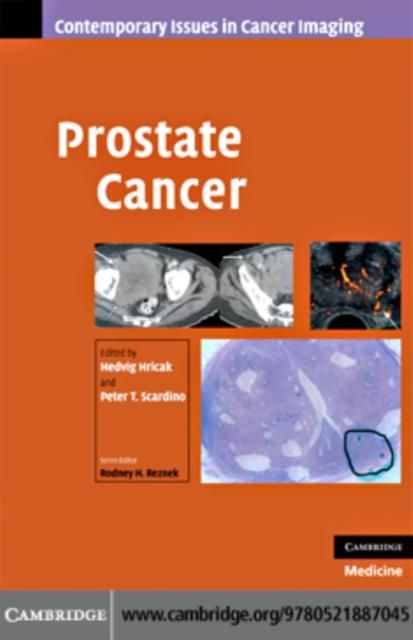 Produktbild: Prostate Cancer