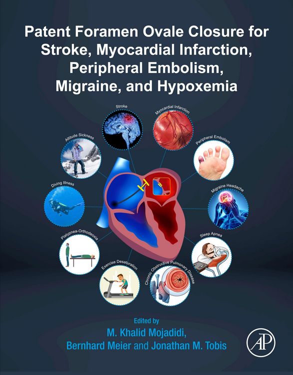 Produktbild: Patent Foramen Ovale Closure for Stroke, Myocardial Infarction, Peripheral Embolism, Migraine, and Hypoxemia