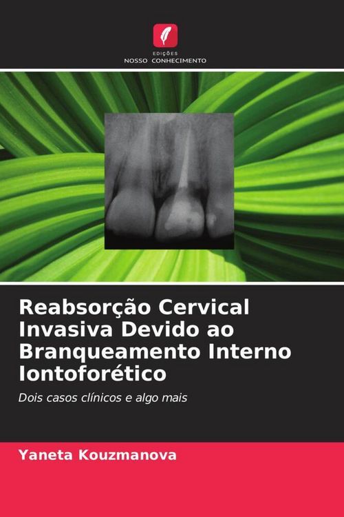Produktbild: Reabsor&ccedil;&atilde;o Cervical Invasiva Devido ao Branqueamento Interno Iontofor&eacute;tico