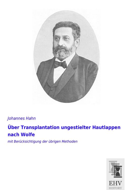 Produktbild: &Uuml;ber Transplantation ungestielter Hautlappen nach Wolfe