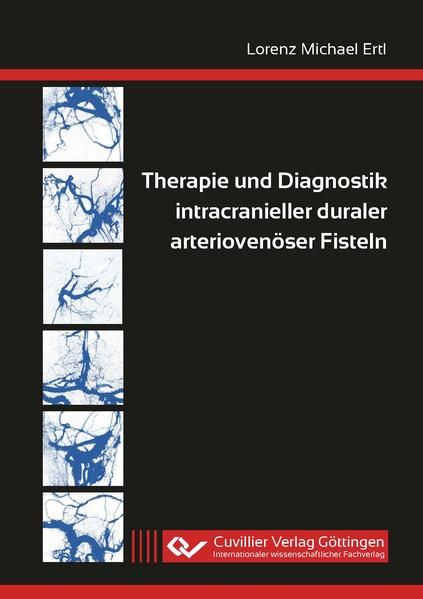 Produktbild: Therapie und Diagnostik intracranieller duraler arterioven&ouml;ser Fisteln