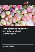 Produktbild: Risonanza magnetica dei tubercolomi intracranici