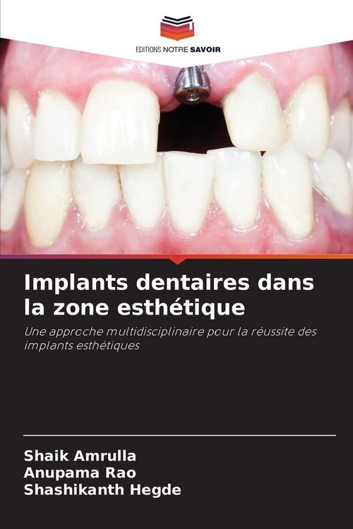 Produktbild: Implants dentaires dans la zone esth&eacute;tique