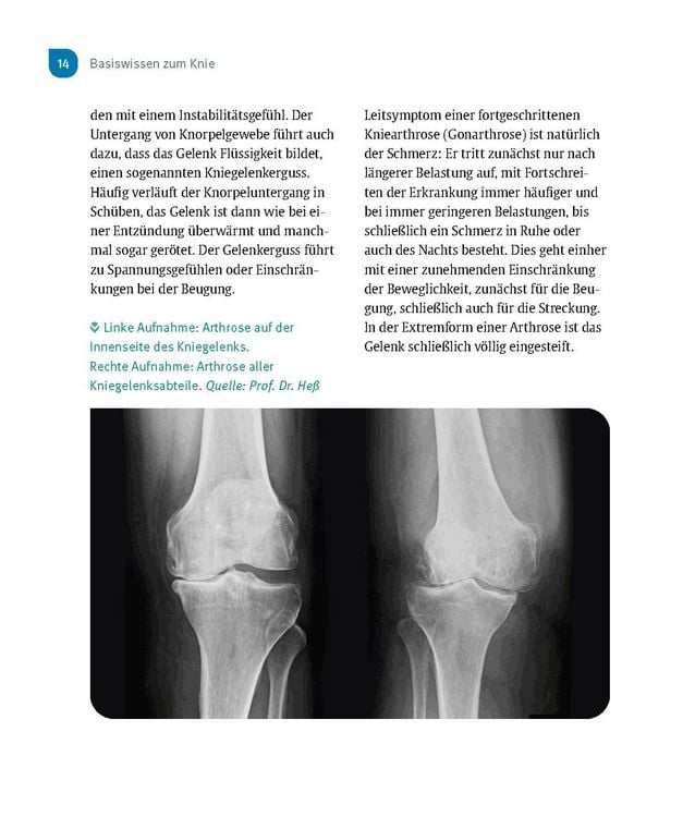 Produktbild: Schmerzfrei & beweglich mit dem neuen Kniegelenk
