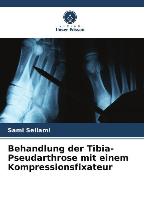Produktbild: Behandlung der Tibia-Pseudarthrose mit einem Kompressionsfixateur