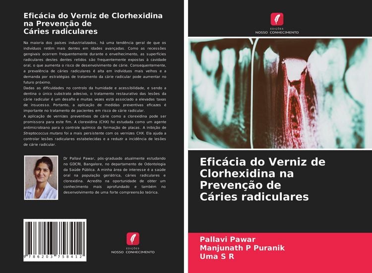 Produktbild: Efic&aacute;cia do Verniz de Clorhexidina na Preven&ccedil;&atilde;o de C&aacute;ries radiculares