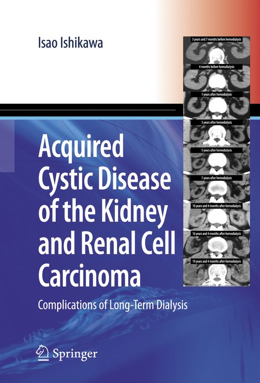 Produktbild: Acquired Cystic Disease of the Kidney and Renal Cell Carcinoma
